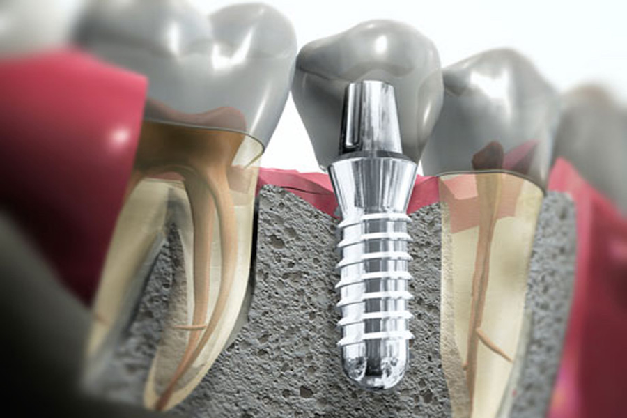 Impiantologia denti
