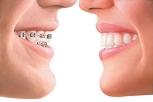 Ortodonzia apparecchi